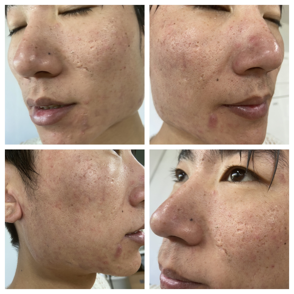 co2 fractional laser treatment