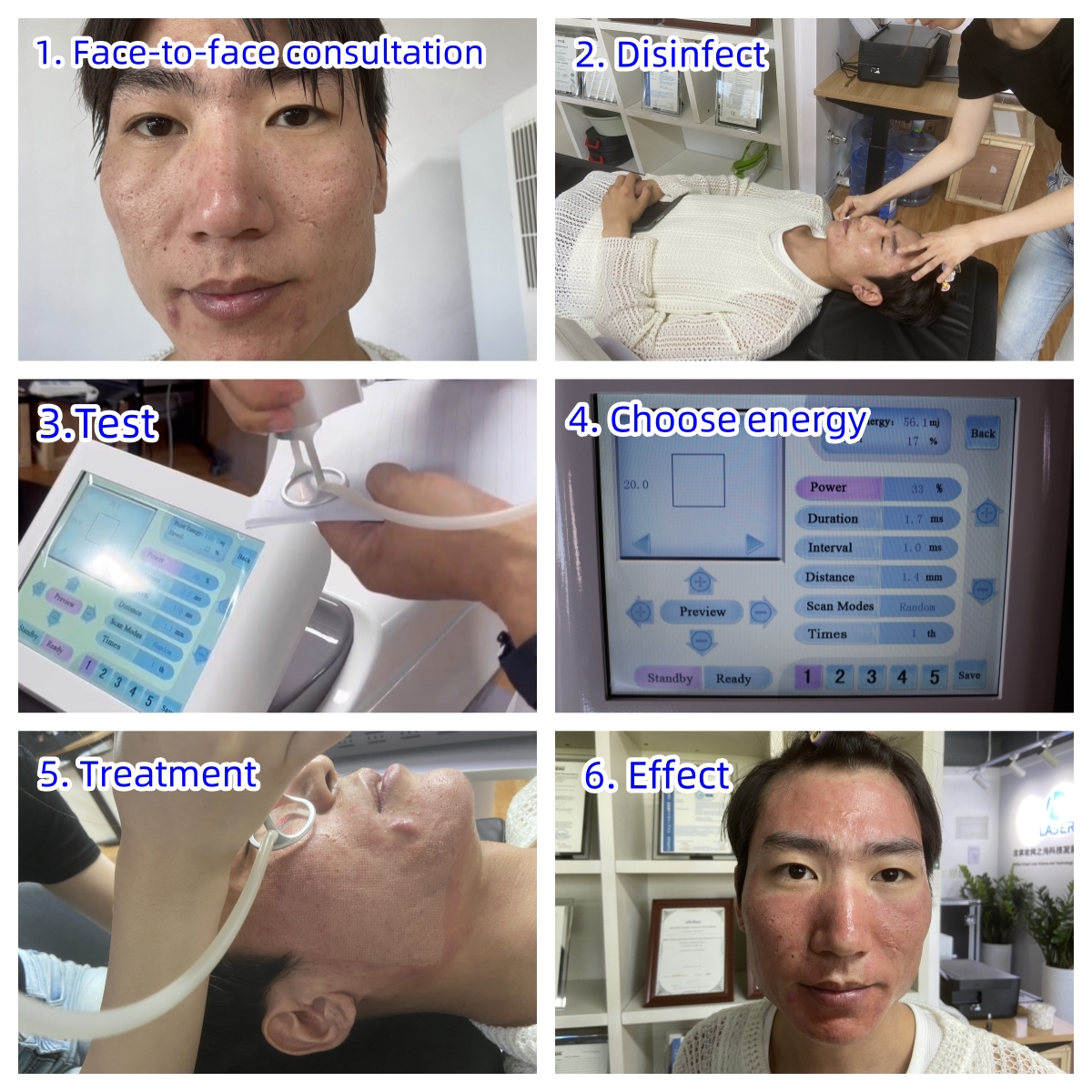 co2 fractional laser treatment