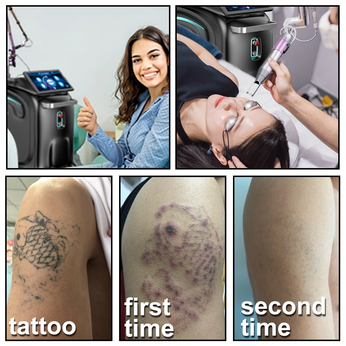 Tattoo Removal Machine